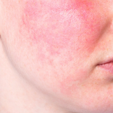 The Healing Benefits of Red Light Therapy For Rosacea