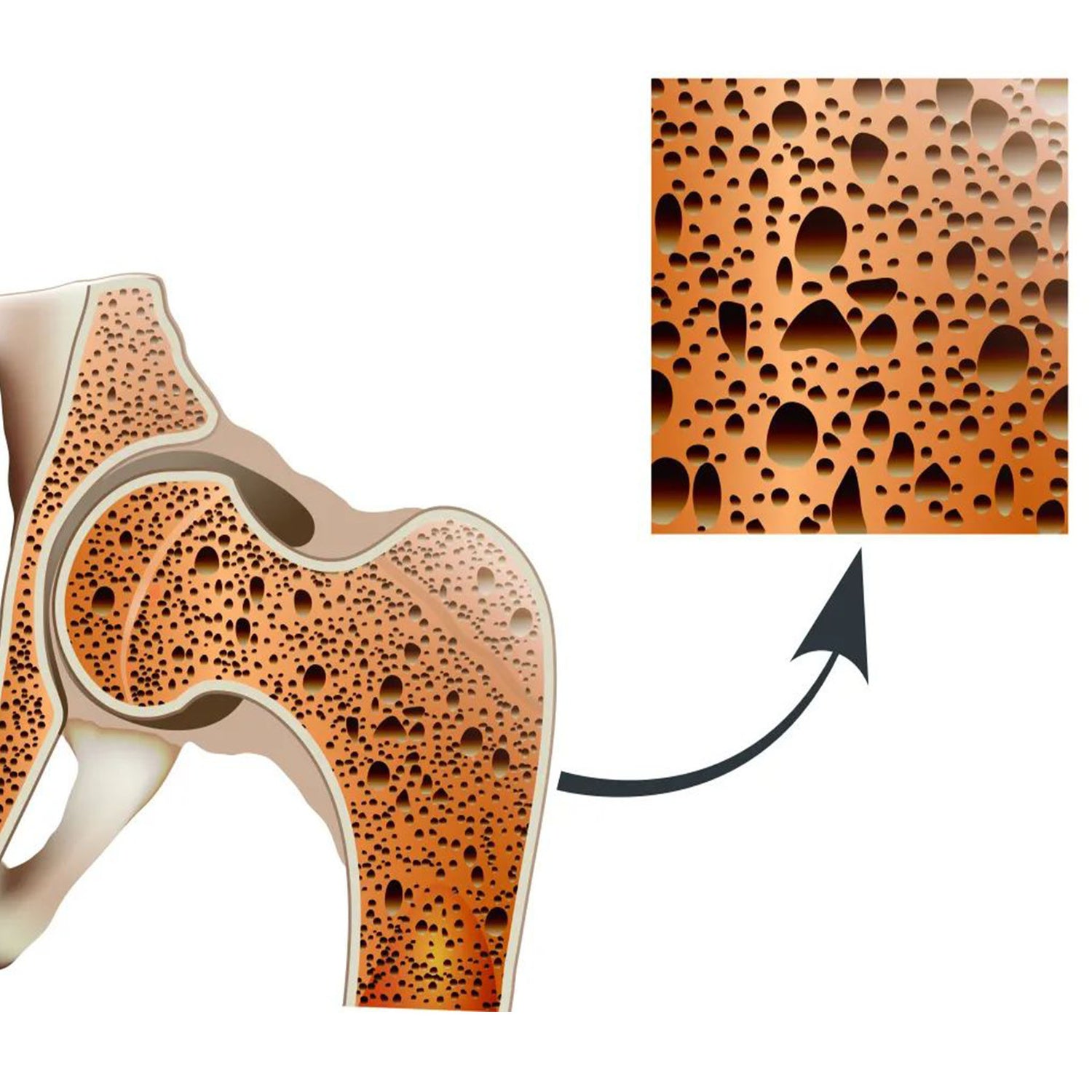 Can Red Light Therapy Help Osteoporosis?