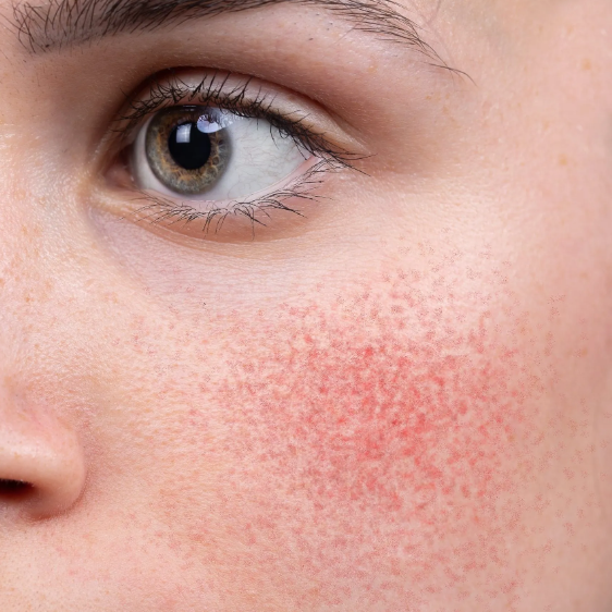 Does Red Light Therapy Help Rosacea?