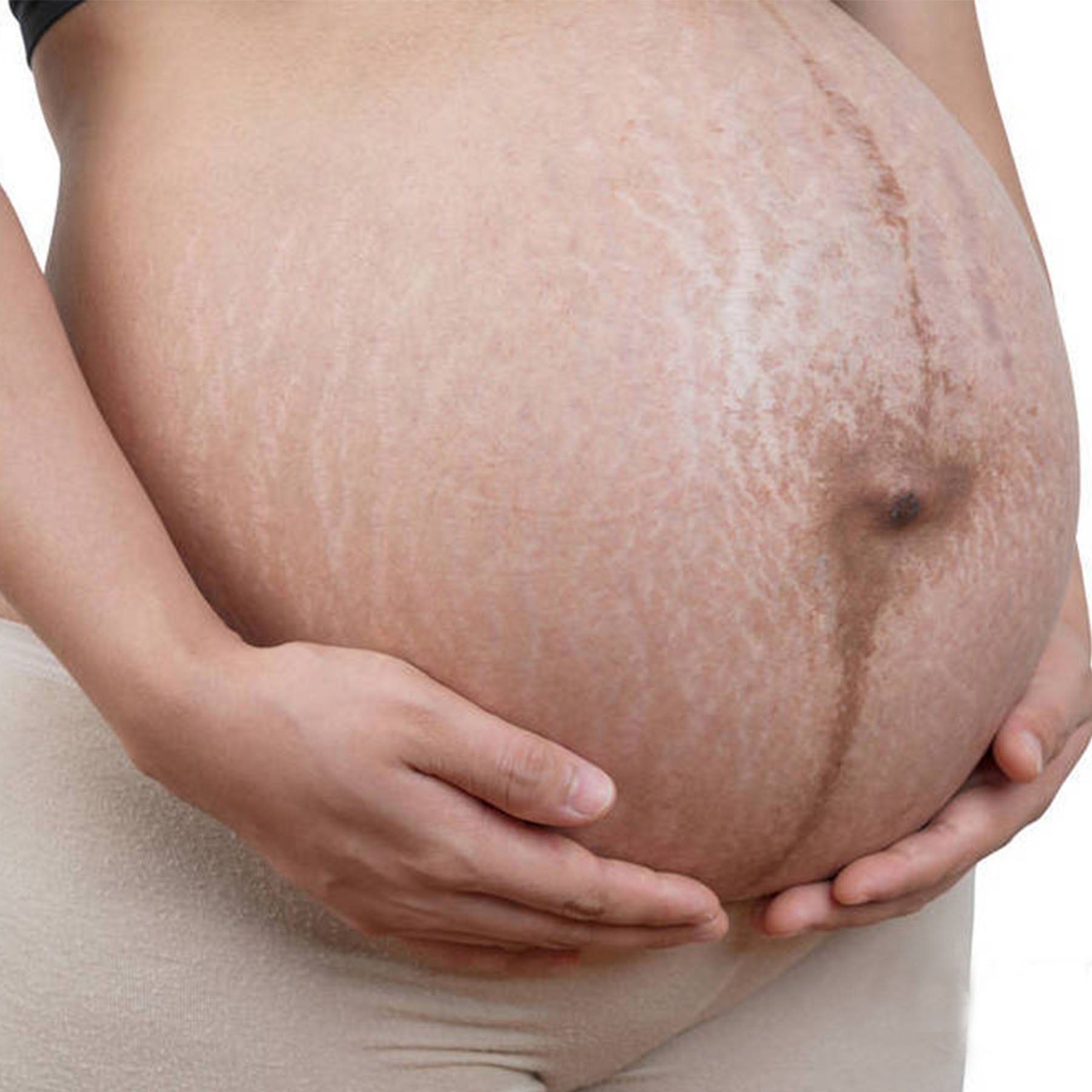 Does Red Light Therapy Help With The Stretch Marks? Bontanny